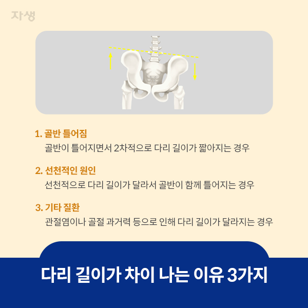 다리 길이가 차이나는 이유 3가지 - 1.골반 틀어짐: 골반이 틀어지면서 2차적으로 다리 길이가 짧아지는 경우 2.선천적인 원인: 선천적으로 다리 길이가 달라서 골반이 함께 틀어지는 경우 3.기타 질환:관절염이나 골절 과거력 등으로 인해 다리 길이가 달라지는 경우 | 자생한방병원·자생의료재단