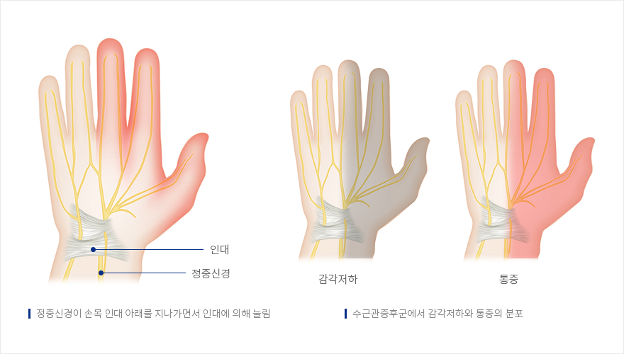 수근관증후군에서 감각저하와 통증의 분포 - 정중신경이 손목 인대 아래를 지나가면서 인대에 의해 눌림 | 자생의료재단