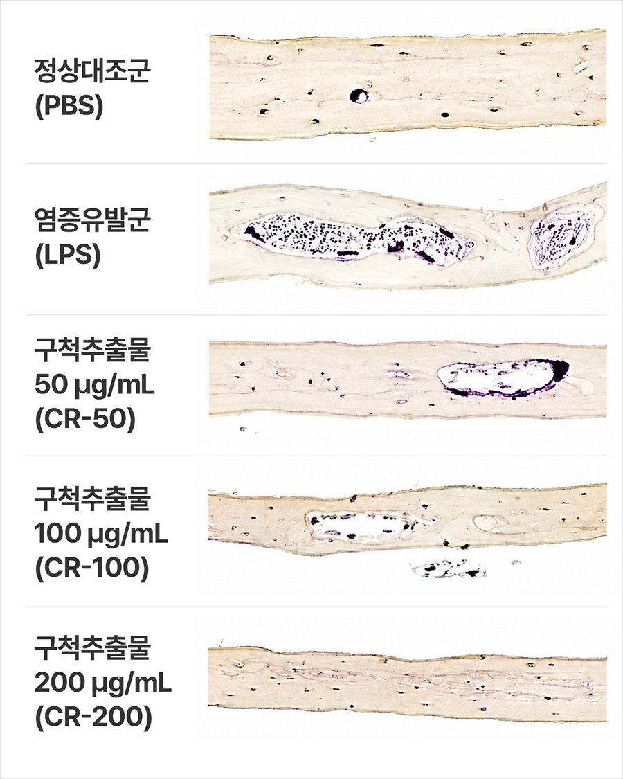 실험쥐 머리뼈 조직 내 골 염증 유발군(LPS)에서 급증했던 파골세포(보라색)와 골미란 현상이 구척(CR) 추출물 투여 농도가 높아질수록 현저히 감소했으며, 최고 농도(CR-200)에서는 정상 대조군(PBS)과 유사한 수준으로 회복됐다. | 자생한방병원・자생의료재단
