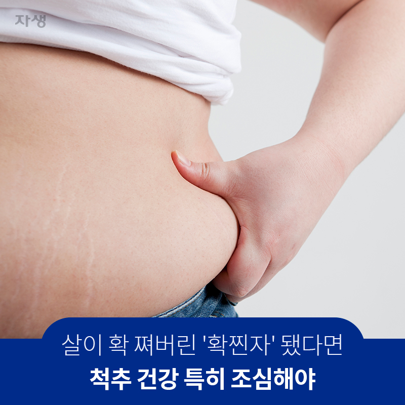 살히 확 쪄버린 확찐자 됐다면 척추 건강 특히 조심해야 | 자생한방병원·자생의료재단