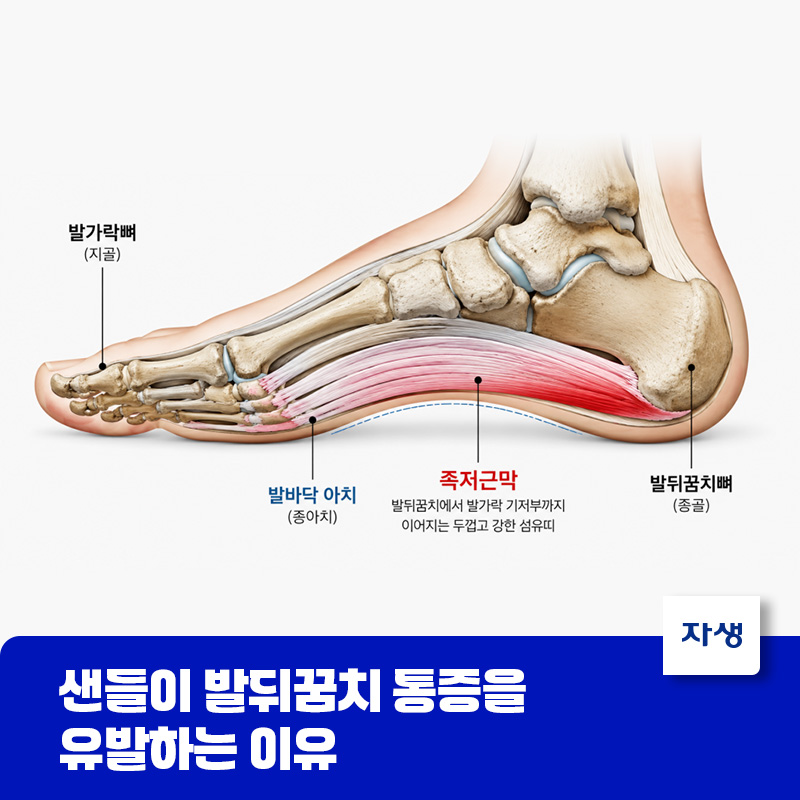 샌들이 발뒤꿈치 통증을 유발하는 이유를 설명하기 위한 인체 모형 이미지