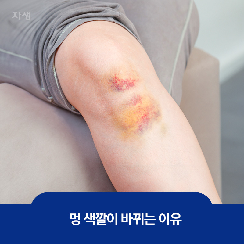 무릎에 든 멍이 주황색으로 바뀐 이미지