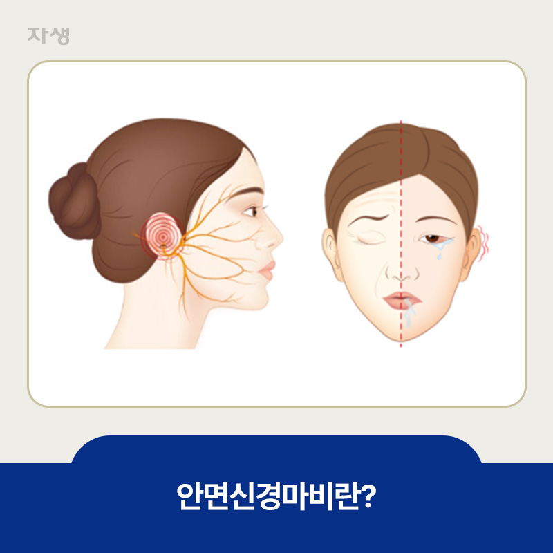 얼굴 근육이 마비되어 한쪽 얼굴을 찡그린 안면신경마비 이미지