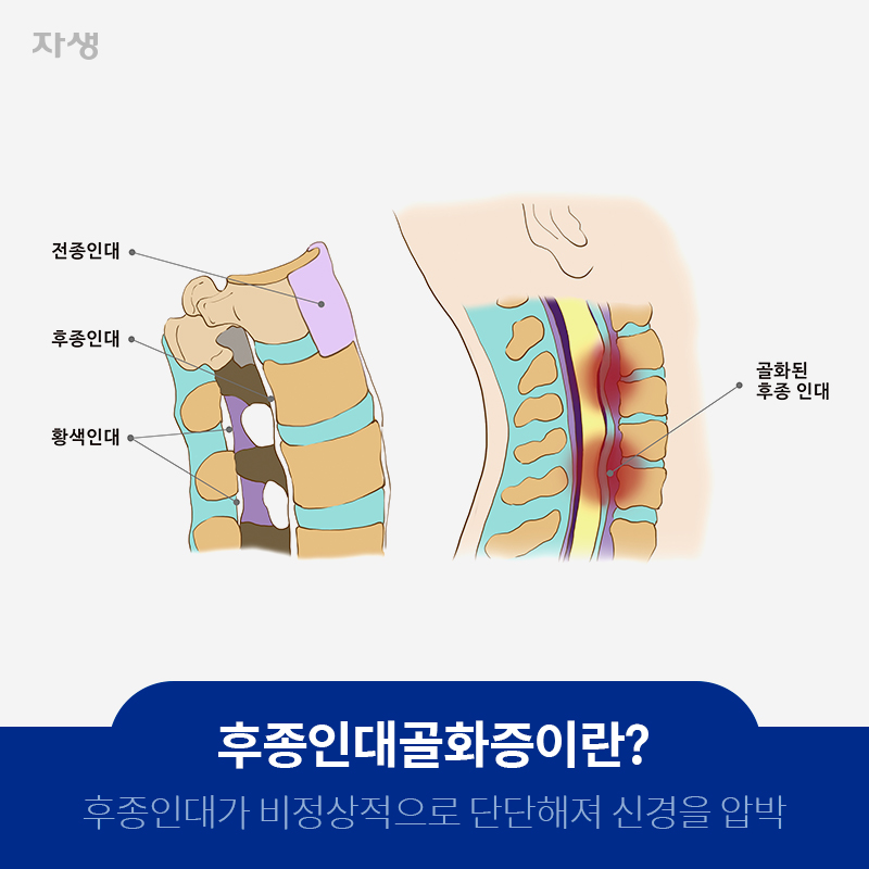 후종인대골화증이란? 후종인대가 비정상적으로 단단해져 신경을 압박 전종인대/후종인대/황색인대/골화된 후종 인대 | 자생한방병원ㆍ자생의료재단