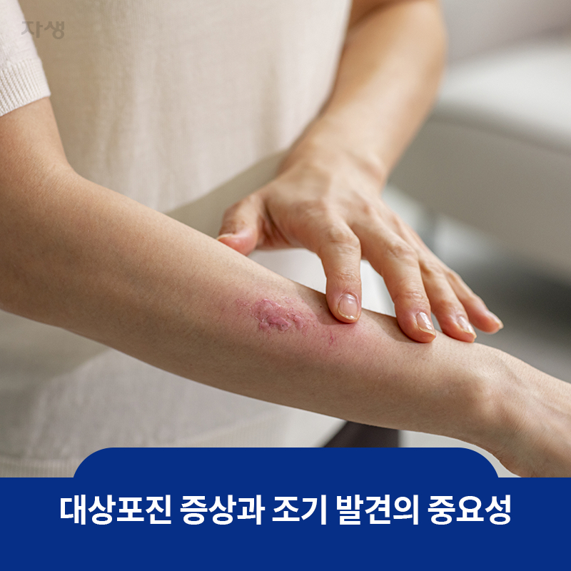 참고 이미지: 대상포진 증상과 조기 발견의 중요성 | 자생한방병원·자생의료재단