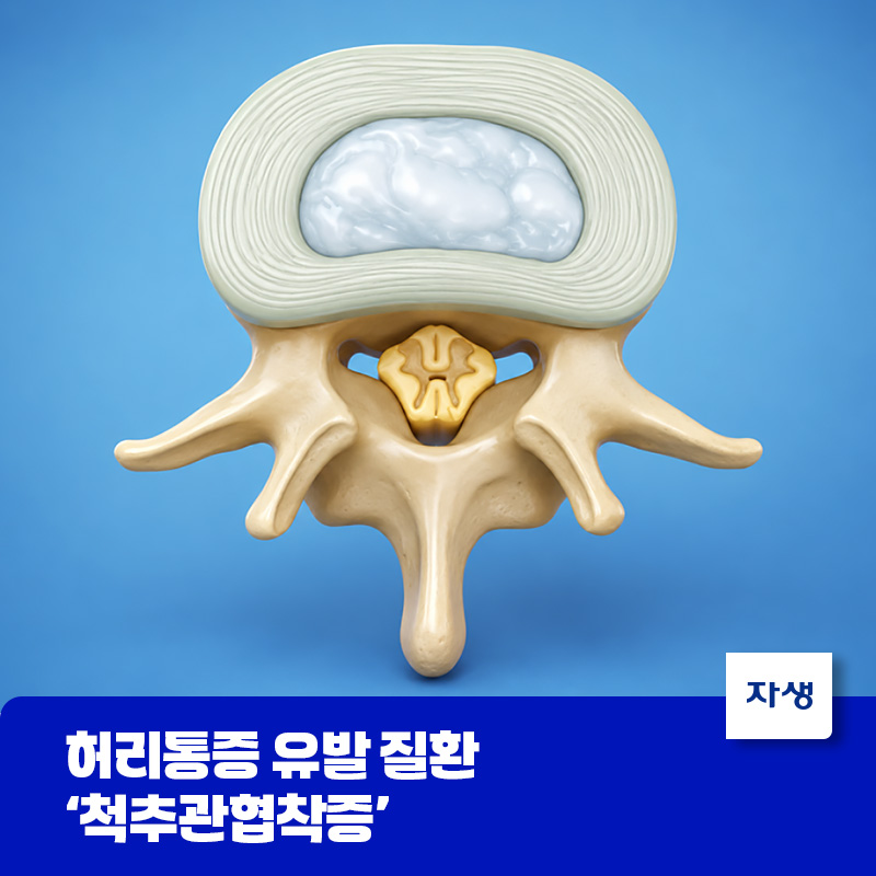 척추관협착증으로 좁아진 척추관과 신경 압박을 나타낸 의료 일러스트