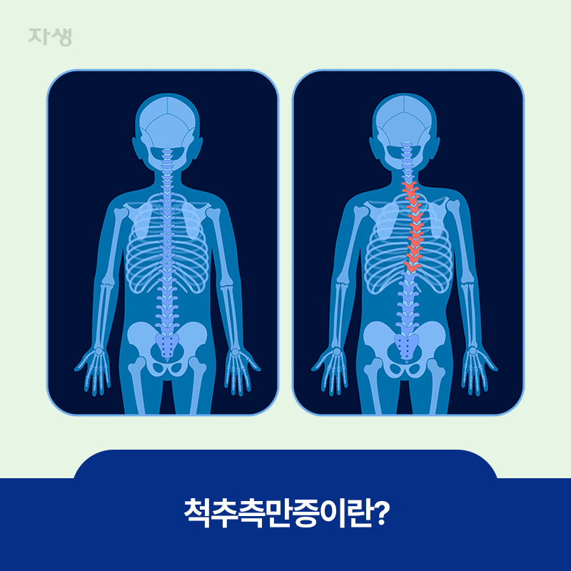 정상과 척추측만증 환자의 뼈 이미지