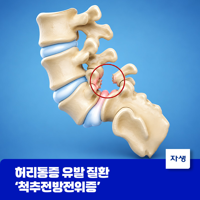 척추전방전위증으로 척추뼈가 앞으로 밀려난 모습을 나타낸 의료 일러스트