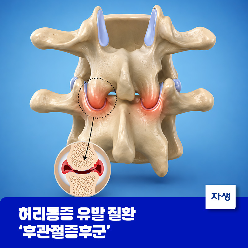 후관절증후군으로 후관절 부위의 염증과 통증을 나타낸 척추 의료 일러스트