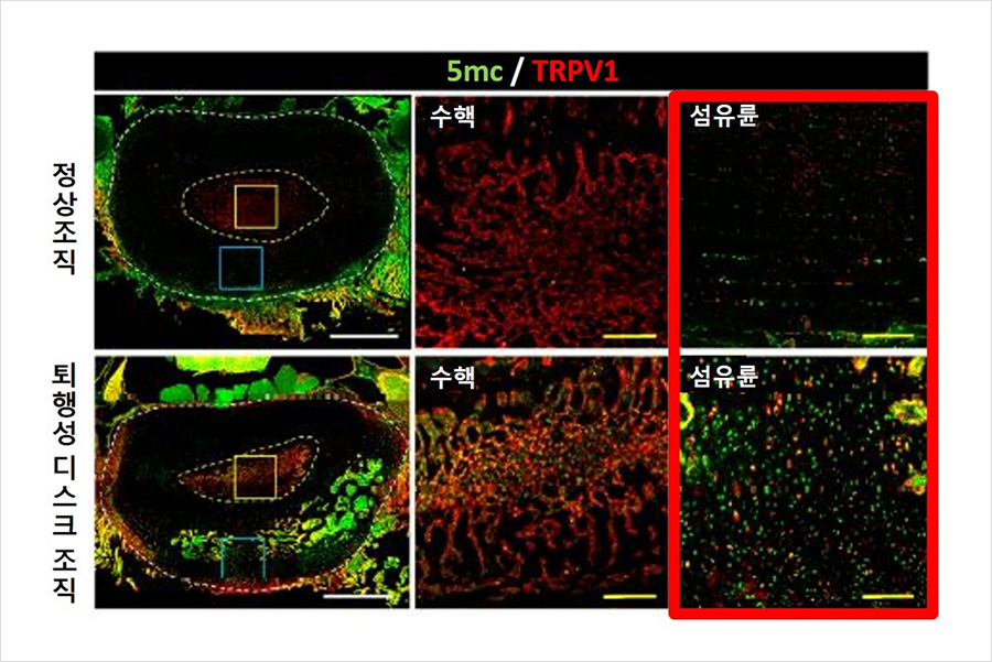 스크 조직 분석 결과 퇴행성 허리디스크 모델의 섬유륜 부위에서 5mC와 TRPV1 발현이 두드러지게 나타났다.  | 자생한방병원・자생의료재단