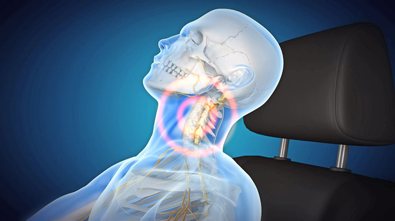 교통사고 발생시 편타성 손상으로 목과 허리의 통증이 발생할 수 있다. | 자생한방병원·자생의료재단