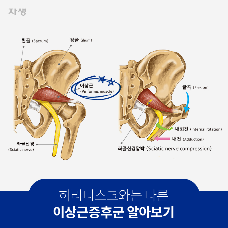 허리디스크와는 다른 이상근증후군 알아보기 | 자생한방병원ㆍ자생의료재단