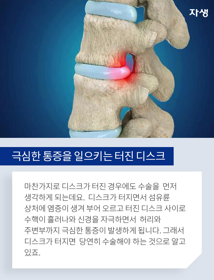 극심한 통증을 일으키는 터진 디스크 - 마찬가지로 디스크가 터진 경우에도 수술을  먼저 생각하게 되는데요.  디스크가 터지면서 섬유륜 상처에 염증이 생겨 부어 오르고 터진 디스크 사이로 수핵이 흘러나와 신경을 자극하면서  허리와 주변부까지 극심한 통증이 발생하게 됩니다. 그래서 디스크가 터지면  당연히 수술해야 하는 것으로 알고 있죠.