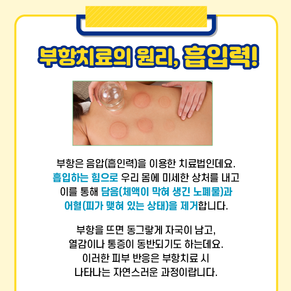 참고 이미지 : 부항치료의 원리, 흡입력! 부항은 음압(흡인력)을 이용한 치료법인데요. 흡입하는 힘으로 우리 몸에 미세한 상처를 내고 이를 통해 담음(체액이 막혀 생긴 노폐물)과 어혈(피가 맺혀 있는 상태)을 제거 합니다. 부항을 뜨면 동그랗게 자국이 남고, 열감이나 통증이 동반되기도 하는데요. 이러한 피부 반응은 부항치료 시 나타나는 자연스러운 과정이랍니다. | 자생한방병원·자생의료재단