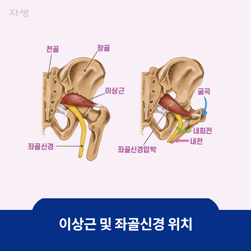 참고 이미지 : 이상근 및 좌골신경 위치 | 자생한방병원·자생의료재단