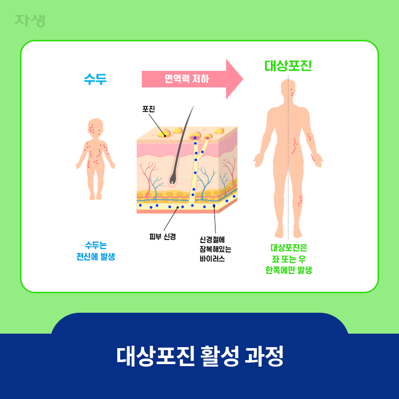 참고이미지 : 대상포진 활성 과정 | 자생한방병원·자생의료재단