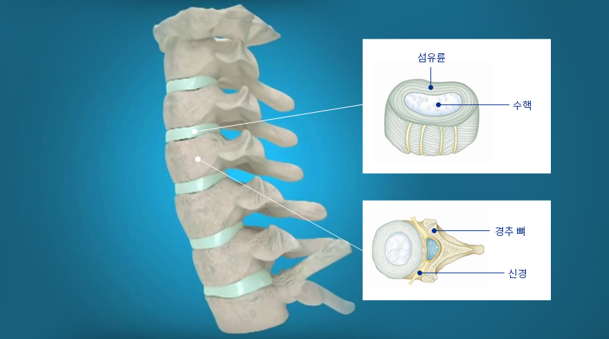 목디스크 구성 - 섬유륜, 수핵, 경추 뼈, 신경 | 자생의료재단