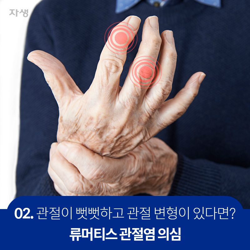 02 관절이 뻣뻣하고 관절 변형이 있다면? 류머티스 관절염 의심 | 자생한방병원·자생의료재단