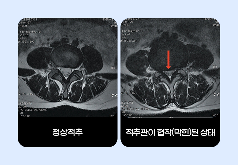 정상척추와 막혀있는 부분이 협착된 곳의 MRI사진 | 자생한방병원·자생의료재단