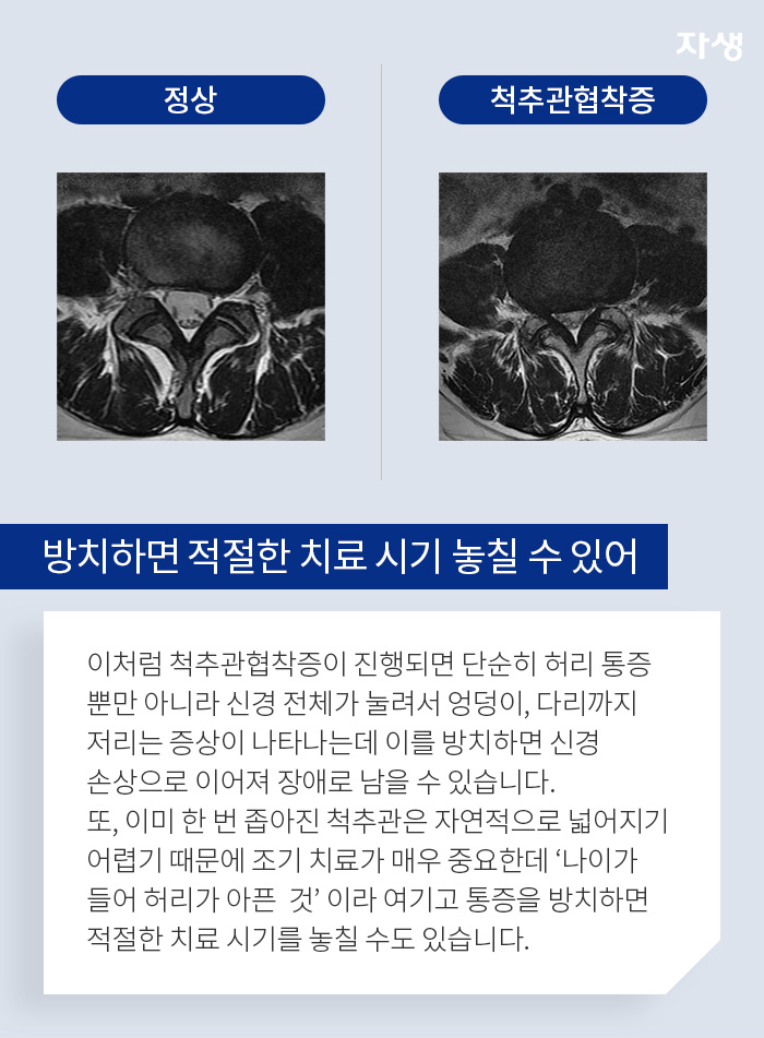 방치하면 적절한 치료 시기 놓칠 수 있어 - 이처럼 척추관협착증이 진행되면 단순히 허리 통증뿐만 아니라 신경 전체가 눌려서 엉덩이, 다리까지 저리는 증상이 나타나는데 이를 방치하면 신경손상으로 이어져 장애로 남을 수 있습니다. 또, 이미 한번 좁아진 척추관은 자연적으로 넓어지기 어렵기 떄문에 조기 치료가 매우 중요한데 나이가 들어 허리가 아픈 것이라 여기고 통증을 방치하면 적절한 치료 시기를 놓칠 수도 있습니다.