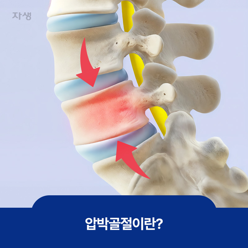 압박골절로 인해 척추뼈가 위아래로 눌려 주저앉은 모습
