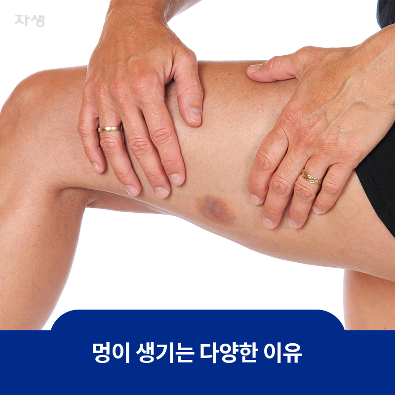 참고 이미지 : 멍이 생기는 다양한 이유 | 자생한방병원·자생의료재단