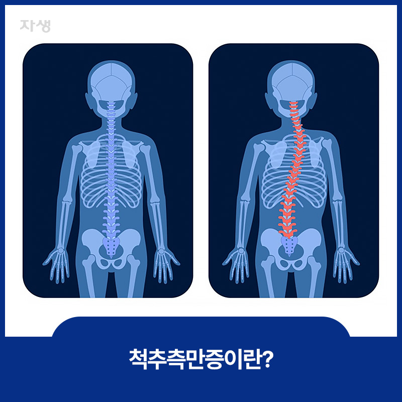 척추측만증 설명을 위한 인체 척추뼈 이미지