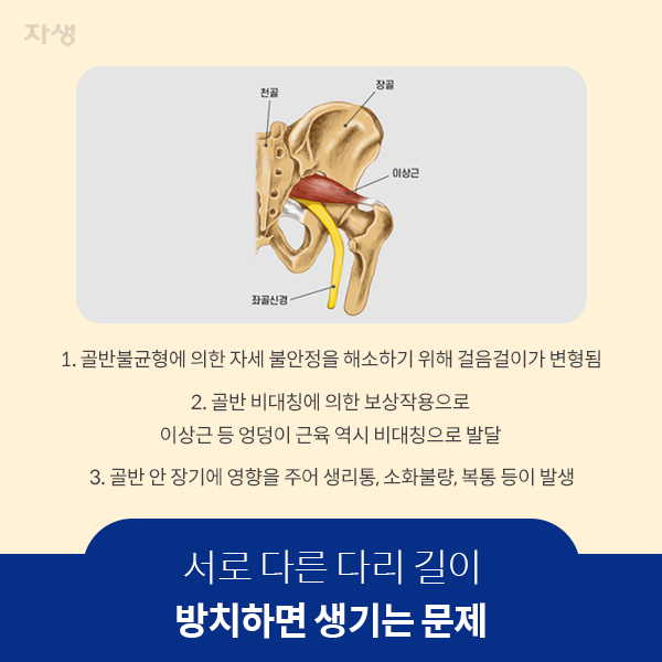 서로 다른 다리 길이 방치하면 생기는 문제 - 1.골반불균형에 의한 자세 불안정을 해소하기 위해 걸음걸이가 변형됨  2.골반 비대칭에 의한 보상작용으로 이상근 등 엉덩이 근육 역시 비대칭으로 발달 3.골반 안 장기에 영향을 주어 생리통, 소화불량, 복통 등이 발생 | 자생한방병원·자생의료재단