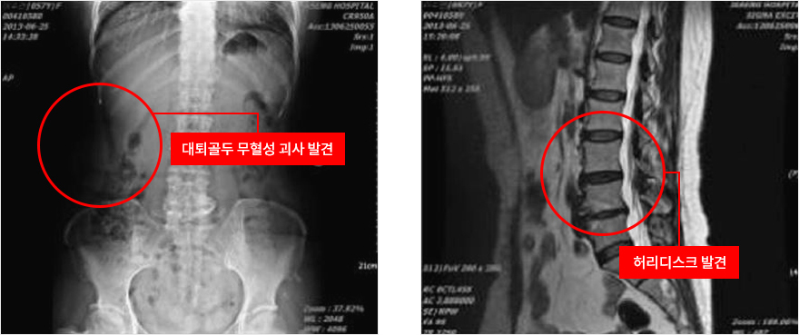 입원 당시 검진 결과 - 대퇴골두 무혈성 괴사 발견, 허리디스크 발견 | 자생의료재단