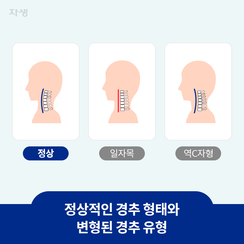 타이틀 이미지 : 정상적인 경추 형태와 변형된 경추 유형 | 자생한방병원·자생의료재단