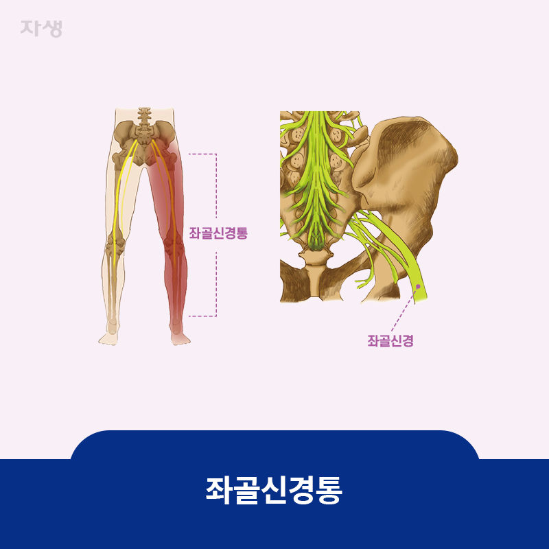 참고 이미지 : 좌골신경통 | 자생한방병원·자생의료재단