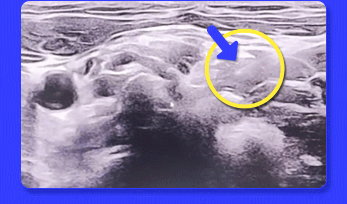 자생한방병원-자생초음파약침