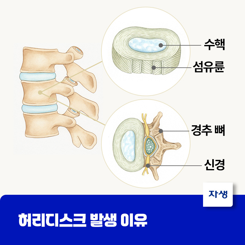 허리디스크 발생 이유를 설명하기 위한 디스크 단면 일러스트 이미지