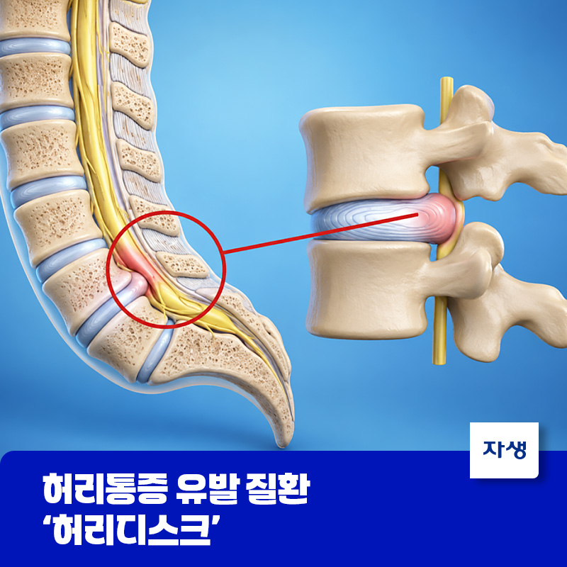 허리디스크(요추추간판탈출증)로 신경이 압박된 모습을 나타낸 척추 의료 일러스트