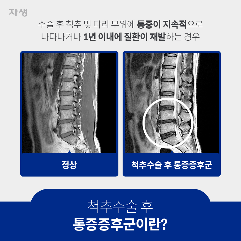 척추수술 후 통증증후군이란? 수술 후 척추 및 다리 부위에 통증이 지속적으로 나타나거나 1년 이내에 질환이 재발하는 경우 정상 / 척추수술 후 통증증후군 | 자생한방병원ㆍ자생의료재단