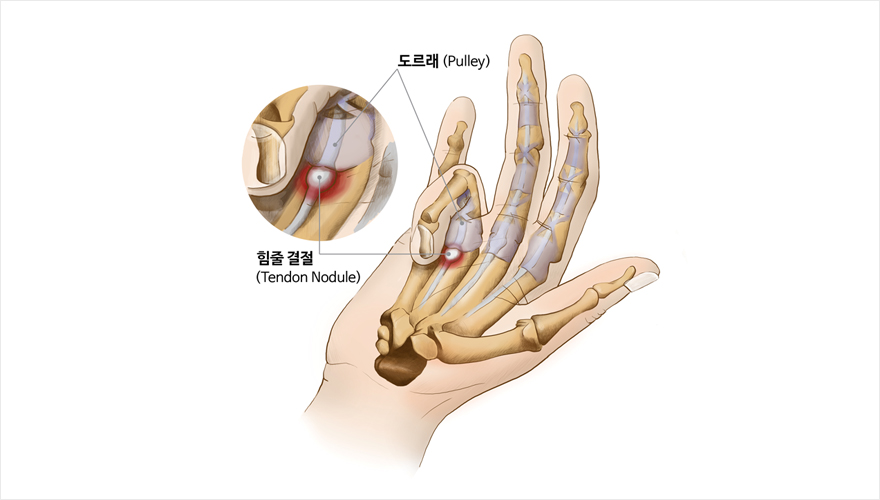 방아쇠 수지 - 도르래, 힘줄 결절 | 자생의료재단