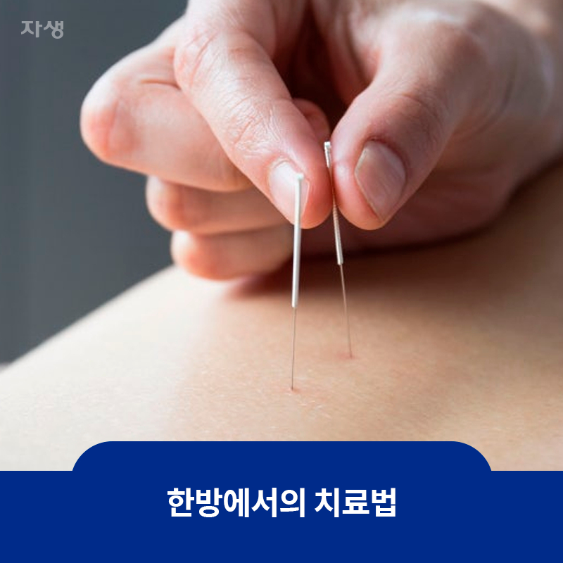 허리에 침을 놓고 있는 이미지