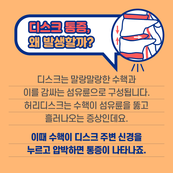 참고 이미지 :  디스크 통증, 왜 발생할까? 디스크는 말랑말랑한 수핵과 이를 감싸는 섬유륜으로 구성됩니다. 허리디스크는 수핵이 섬유륜을 뚫고 흘러나오는 증산인데요. 이때 수핵이 디스크 주변 신경을 누르고 압박하면 통증이 나타나죠. | 자생한방병원·자생의료재단