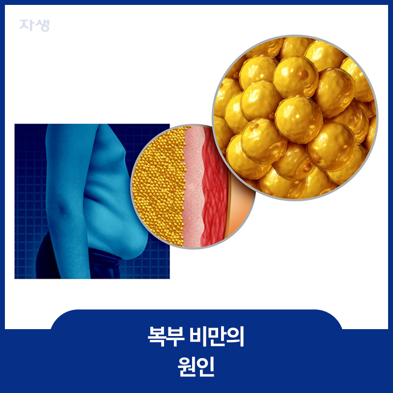 복부 비만의 원인인 복부에 축적된 내장 지방 이미지