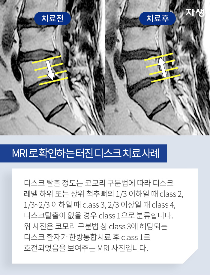 MRI 로 확인하는 터진 디스크 치료 사례-디스크 탈출 정도는 코모리 구분법에 따라 디스크 레벨 하위 또는 상위 척추뼈의 1/3 이하일 때 class 2, 1/3~2/3 이하일 때 class 3, 2/3 이상일 때 class 4, 디스크탈출이 없을 경우 class 1으로 분류합니다.위 사진은 코모리 구분법 상 class 3에 해당되는 디스크 환자가 한방통합치료 후 class 1로 호전되었음을 보여주는 MRI 사진입니다.