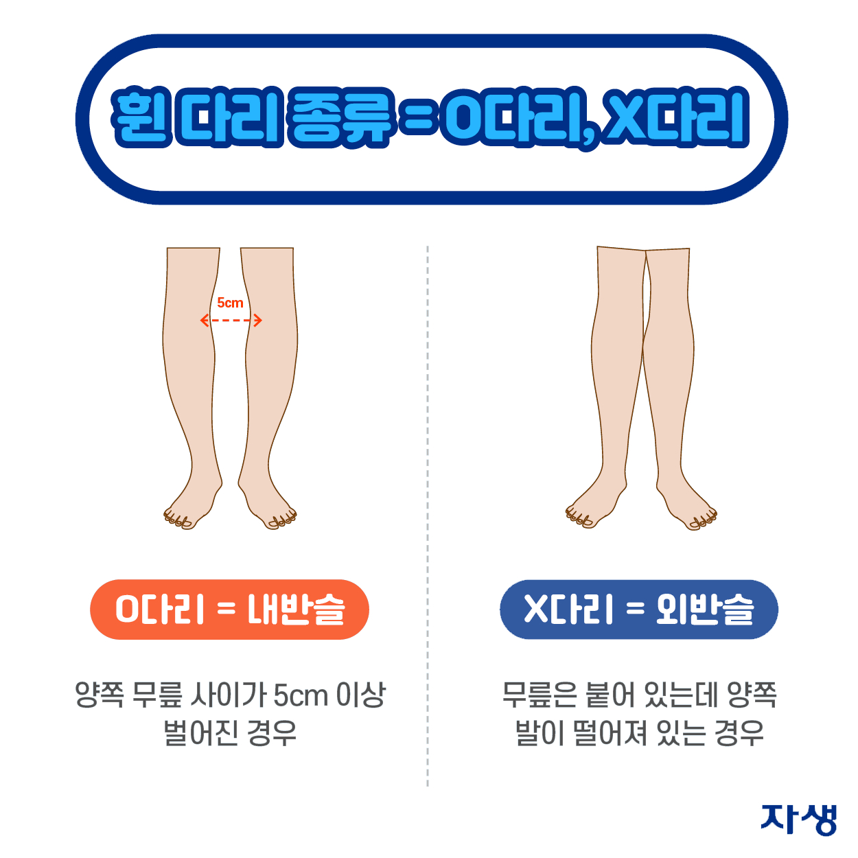 휜 다리 종류 = O다리, X다리 | O다리 = 내반슬 | X다리 + 외반슬 | 자생한방병원·자생의료재단