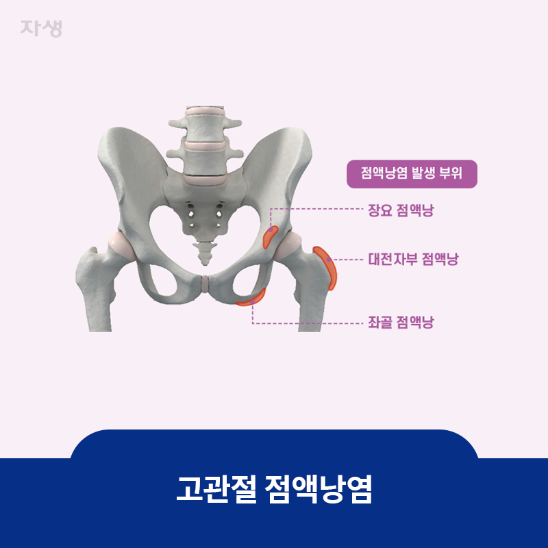 참고 이미지 :  고관절 점액낭염 | 자생한방병원·자생의료재단