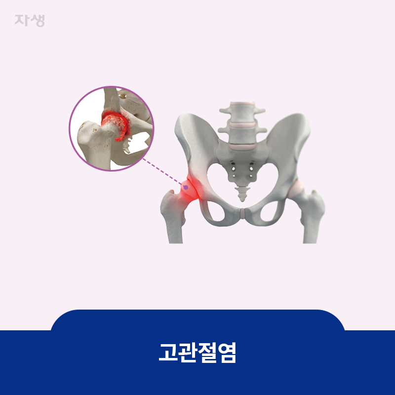 참고 이미지 : 고관절염 | 자생한방병원·자생의료재단