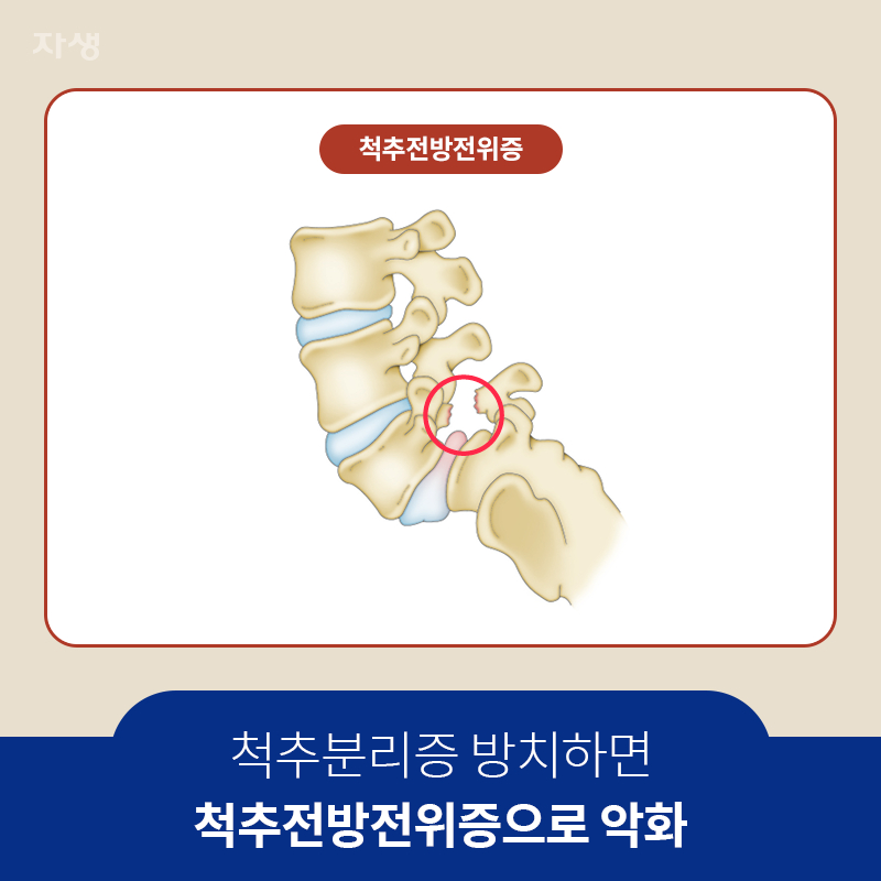 참고 이미지 : 척추분리증 방치하면 척추전방전위증으로 악화 | 자생한방병원·자생의료재단