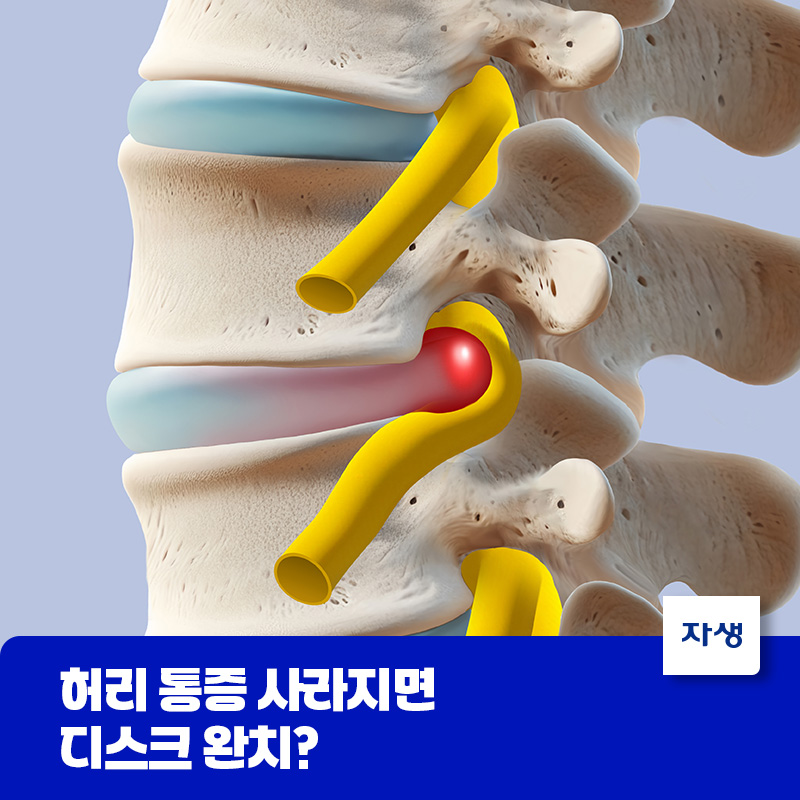 허리 통증과 디스크의 상관관계를 설명하기 위한 척추뼈 이미지