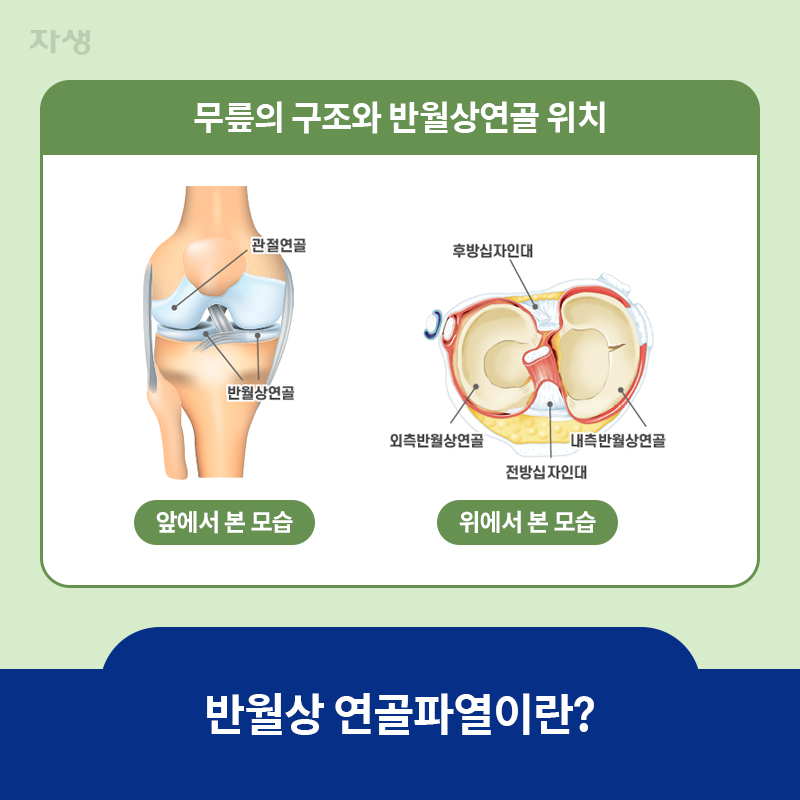 참고 이미지 : 반월상 연골파열이란? | 자생한방병원·자생의료재단