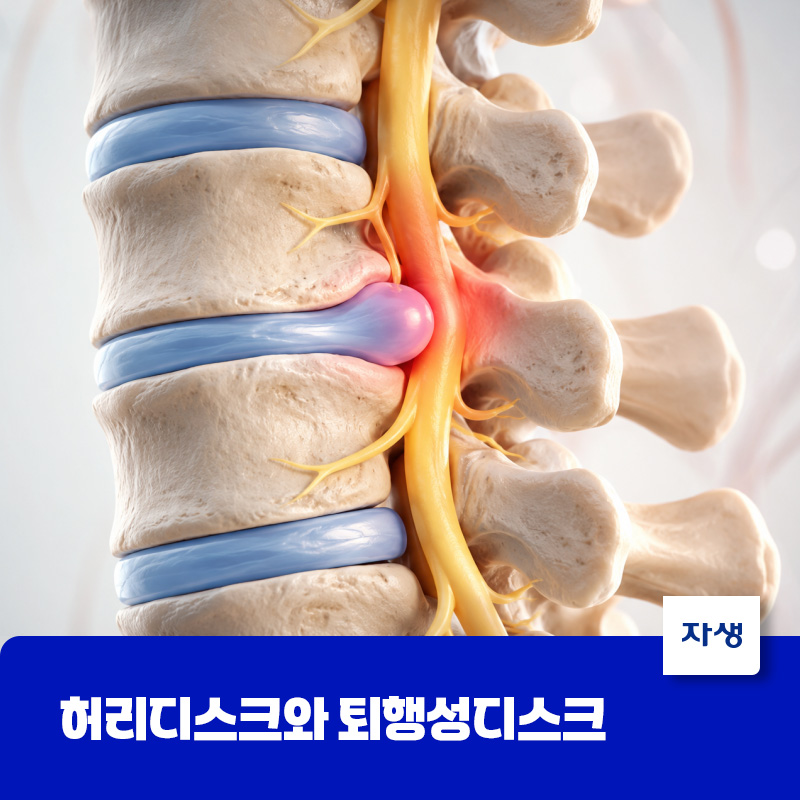 디스크 내부의 수행이 밀려나온 허리디스크 상태를 설명하기 위한 척추 모형 이미지