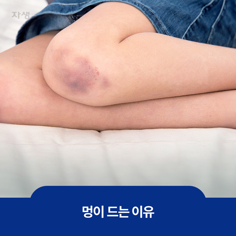 무릎에 멍든 이미지