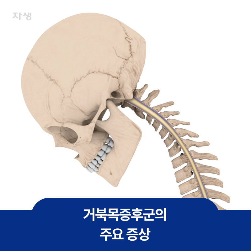 거북목증후군의 주요 특징 중 하나인 구부러진 목의 뼈 이미지