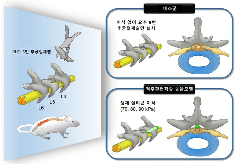 척추뼈의 뒤쪽 부분인 후궁을 잘라 신경이 압박되는 정도를 줄이는 후궁절제술을 실시한 후 경도가 다른 실리콘을 사용해 척추관협착증 동물모델을 설정하기 위한 실험 설계의 개략도 | 자생한방병원·자생의료재단